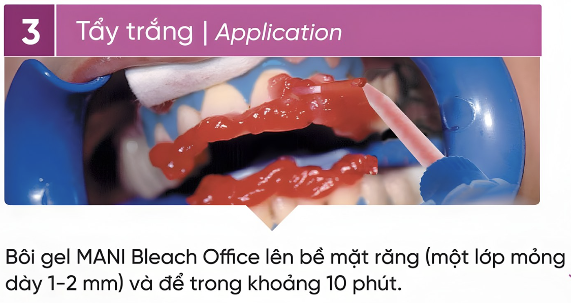 Quy trình tẩy trắng răng🌱không cần chiếu đèn Mani Bleach&rsquo;n Shine🌱NHA KHOA MALL🌱